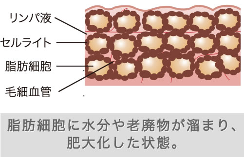 脂肪細胞に水分や老廃物が溜まり、肥大化した状態。